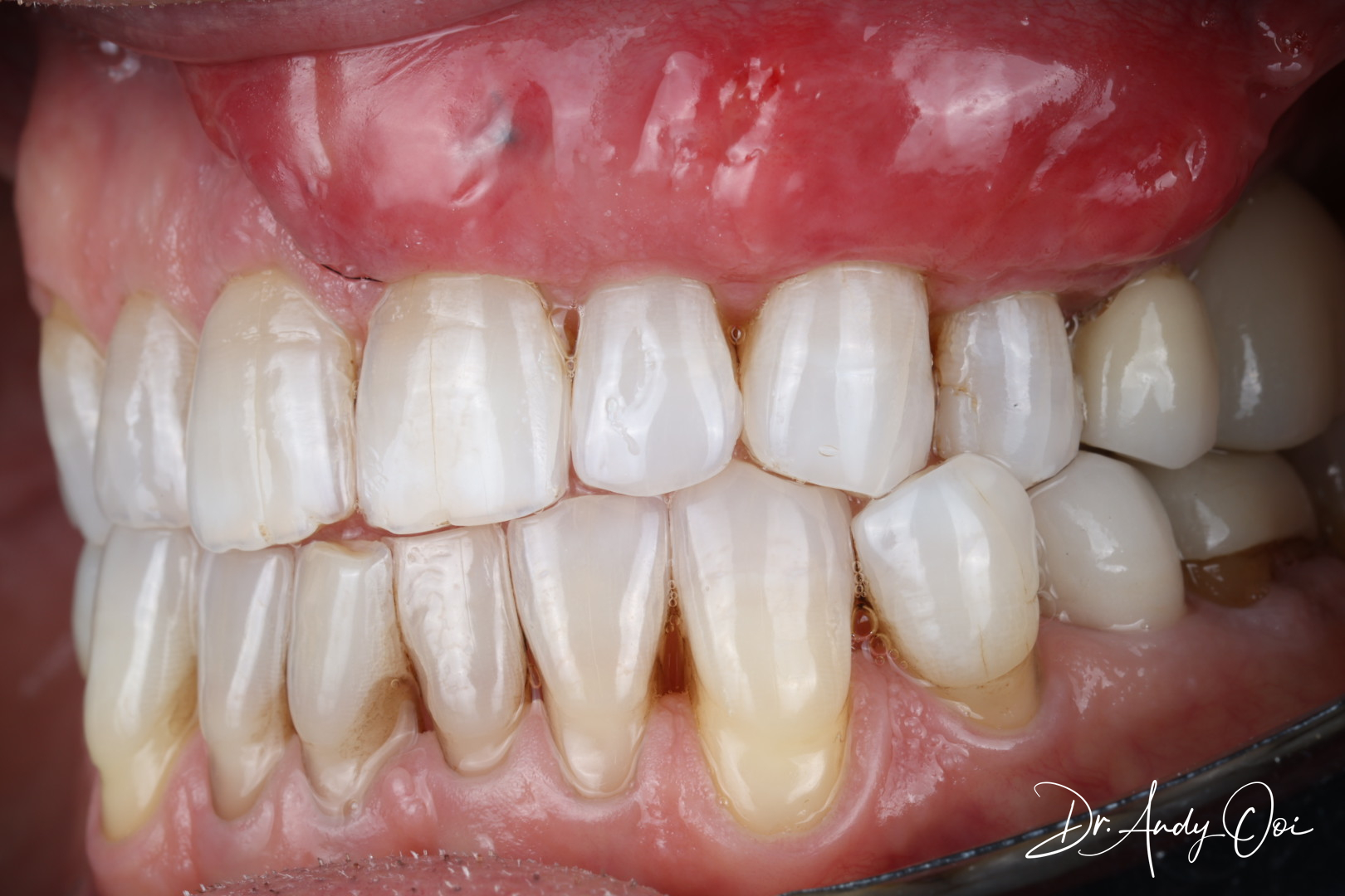 Scaling & Polishing — who it helps