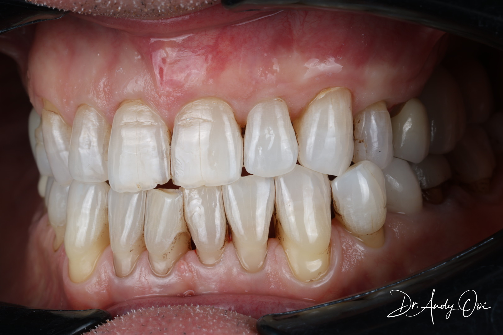 Root Canal Treatment Root Canal Treatment