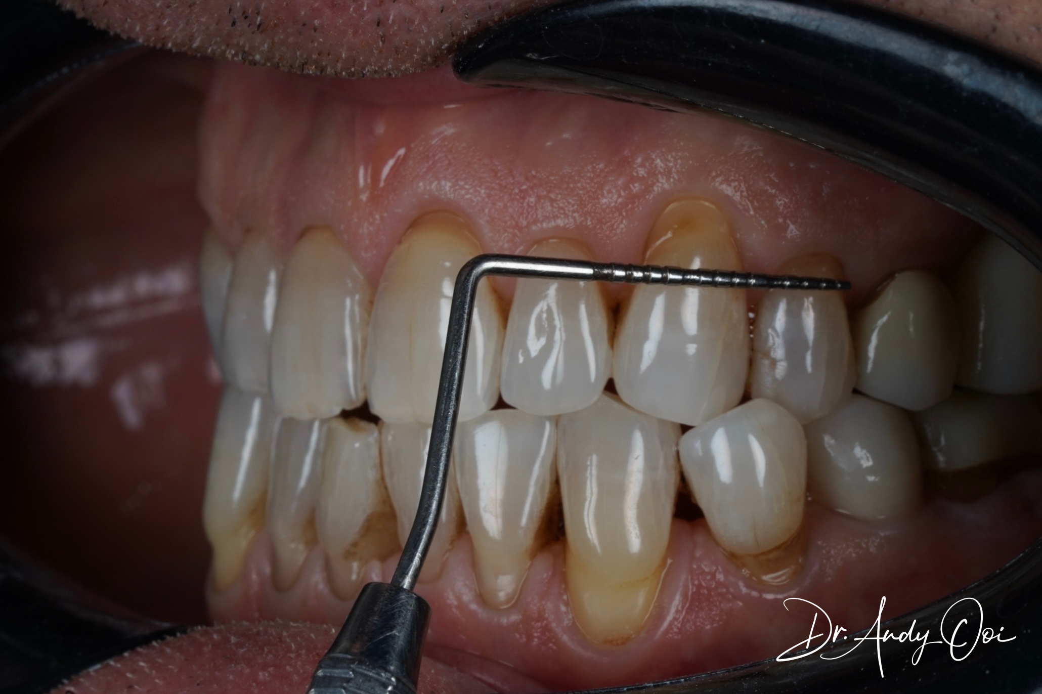 Gum Treatment Gum Treatment — who it helps