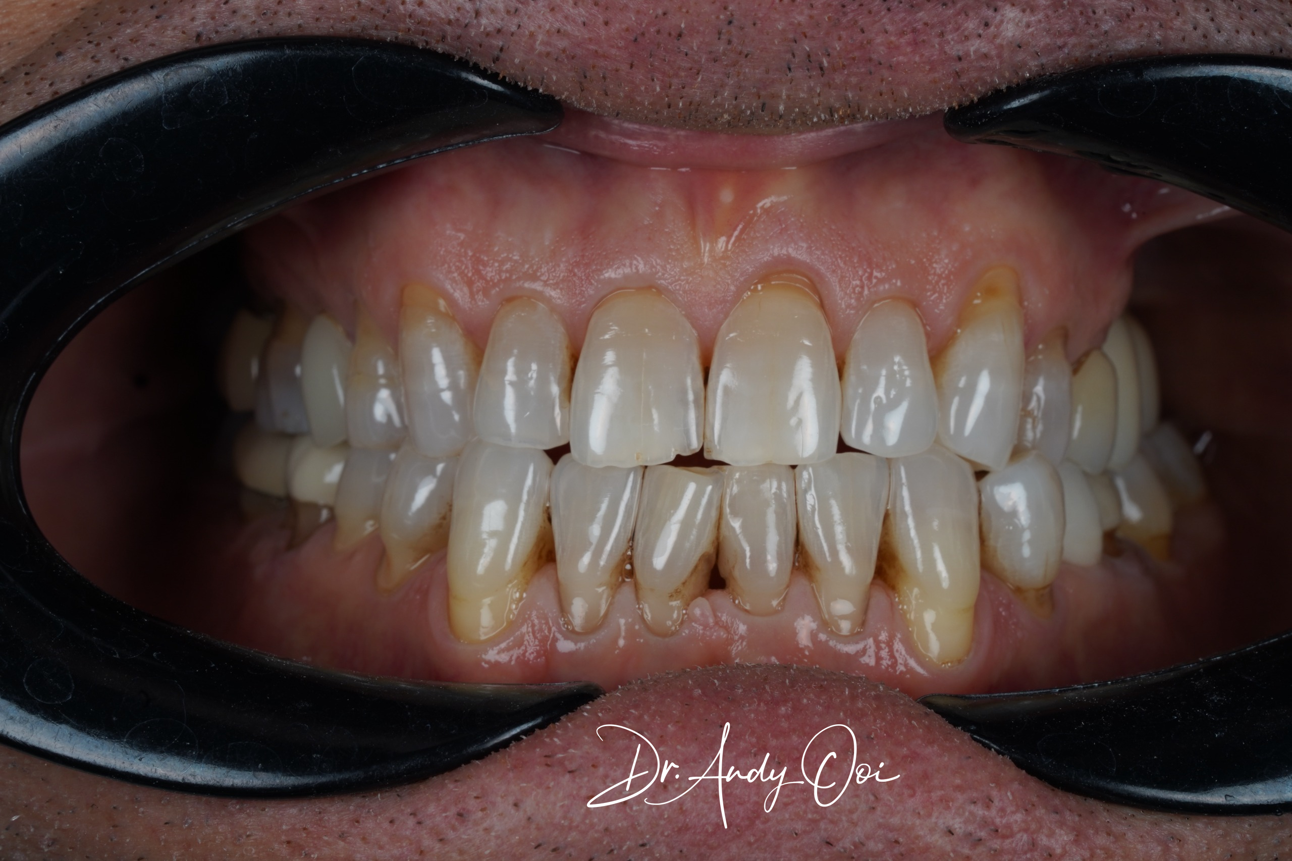 Scaling & Polishing