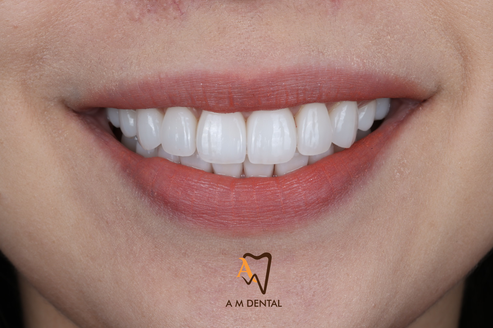 Our Treatments Brighter, refreshed teeth