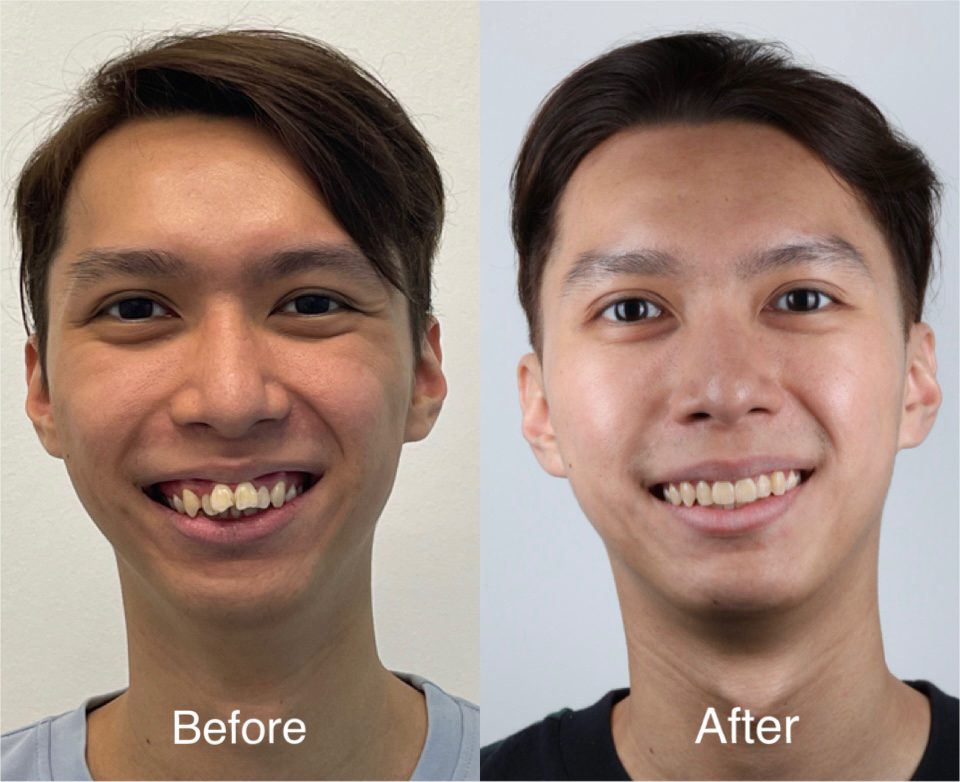 Braces Braces before and after — crowding corrected