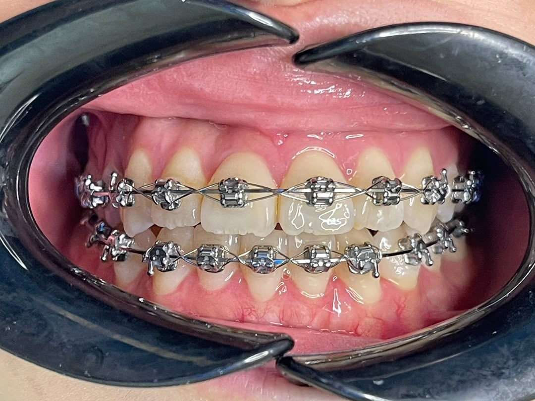 Braces Fixed braces fitted on the upper arch at A M Dental