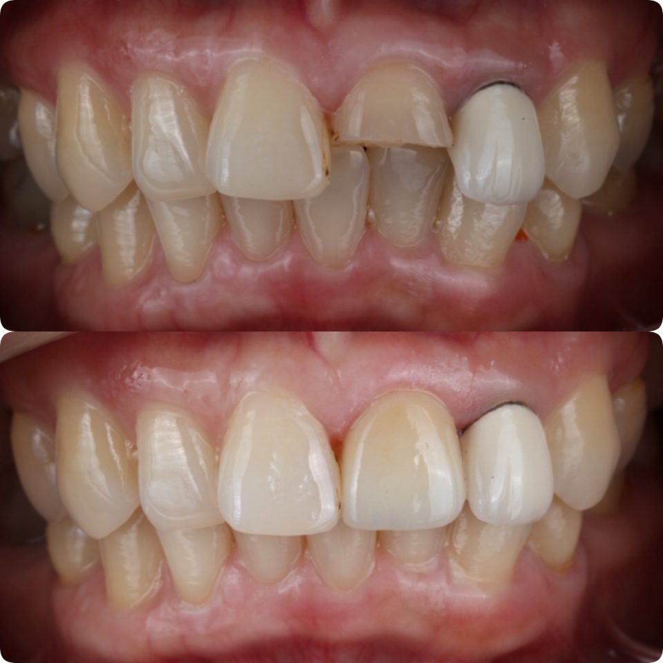 Bridge Dental bridge before and after
