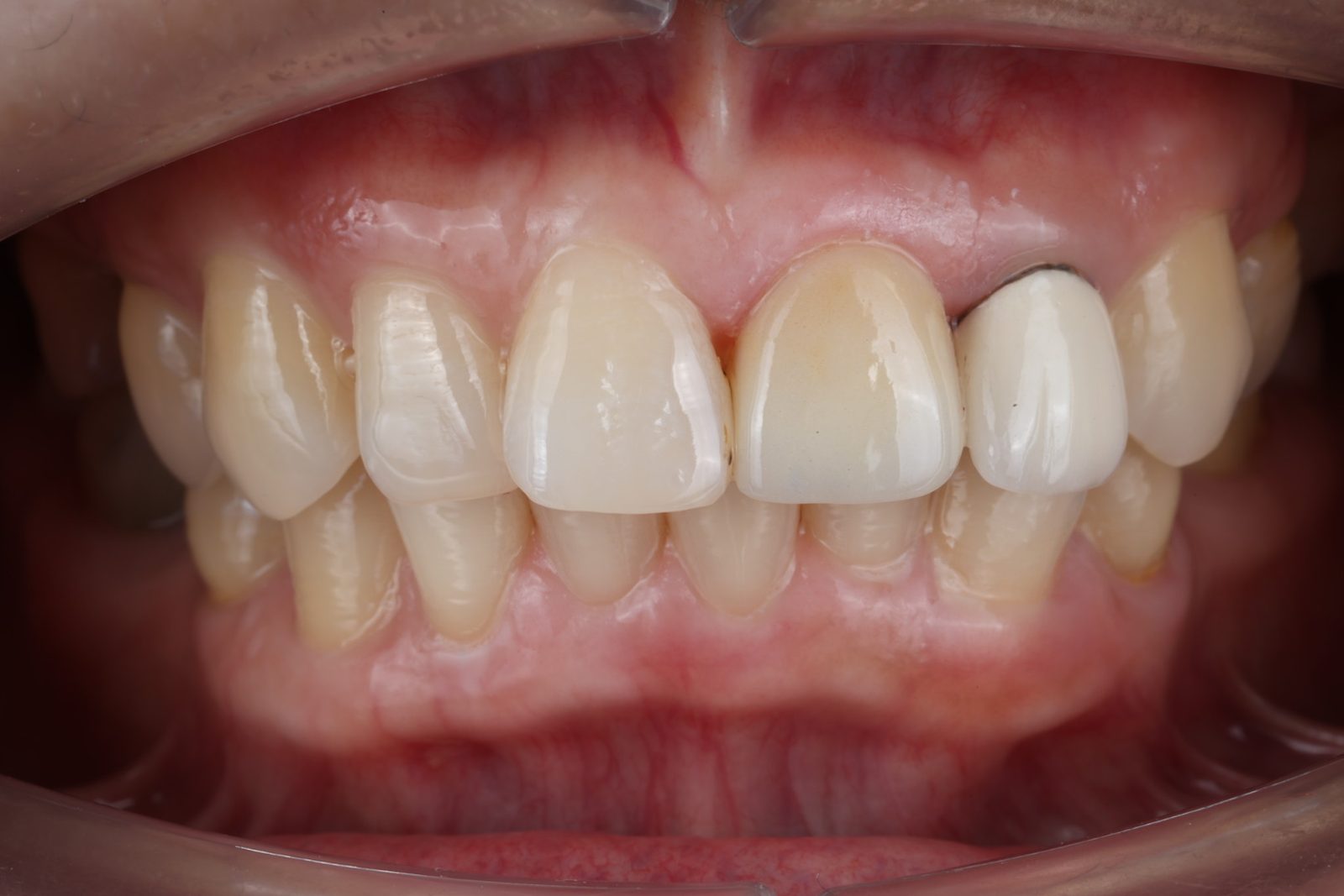 Bridge A completed bridge restoring the front teeth