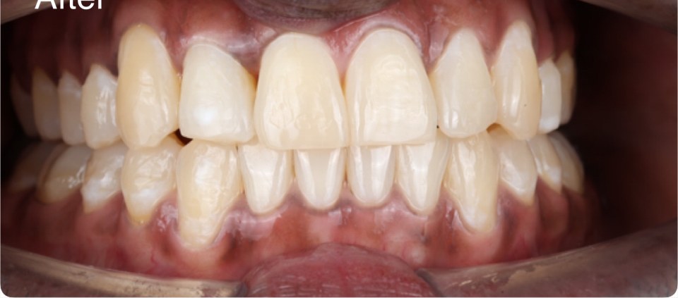 Teeth aligned with clear aligner treatment