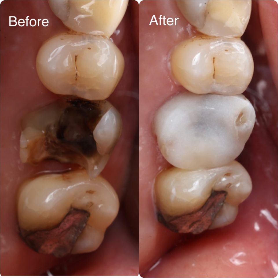 A fractured molar rebuilt with a zirconia crown