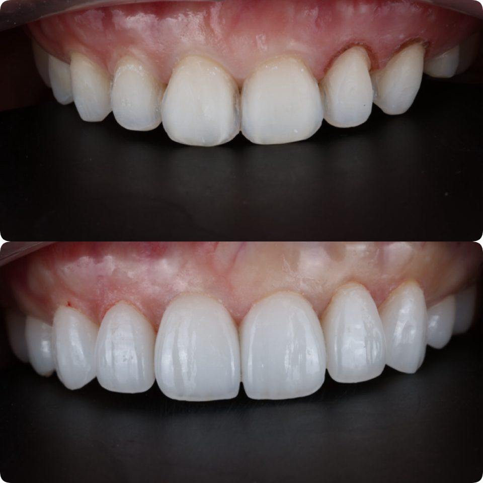 Dental Crown Crowns restoring the upper front teeth