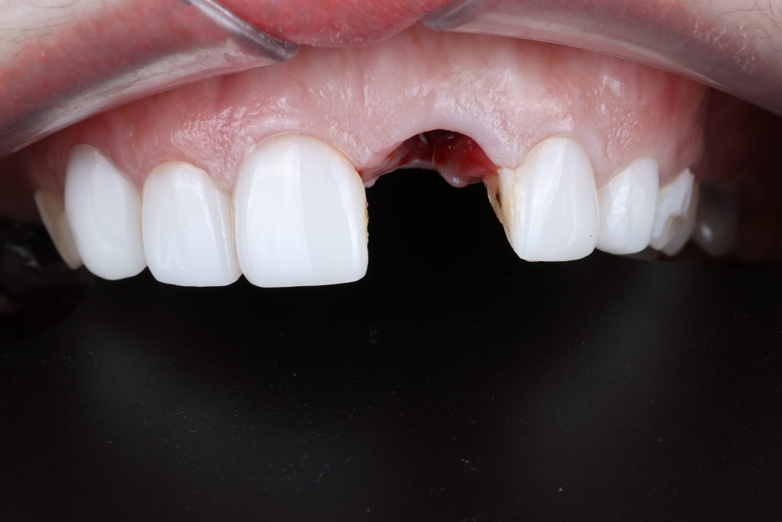 A missing tooth replaced with a dental implant