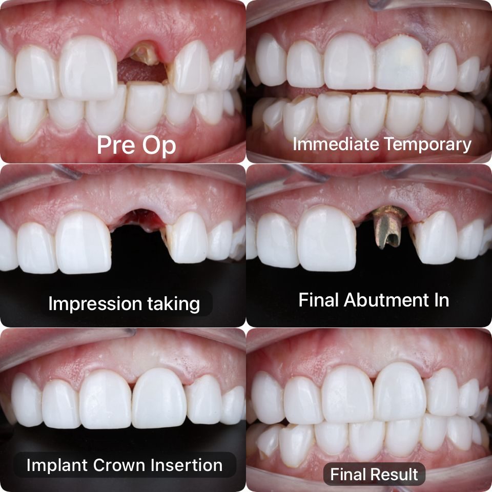 Dental Implants Dental implant treatment stages from pre-op to final result