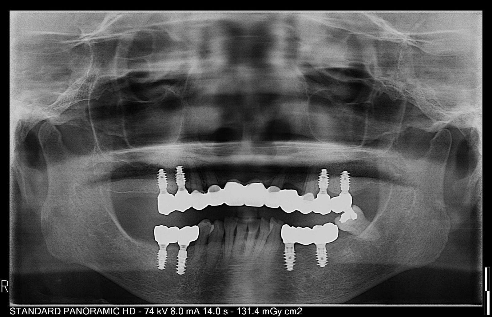 X-Ray A full panoramic dental X-ray