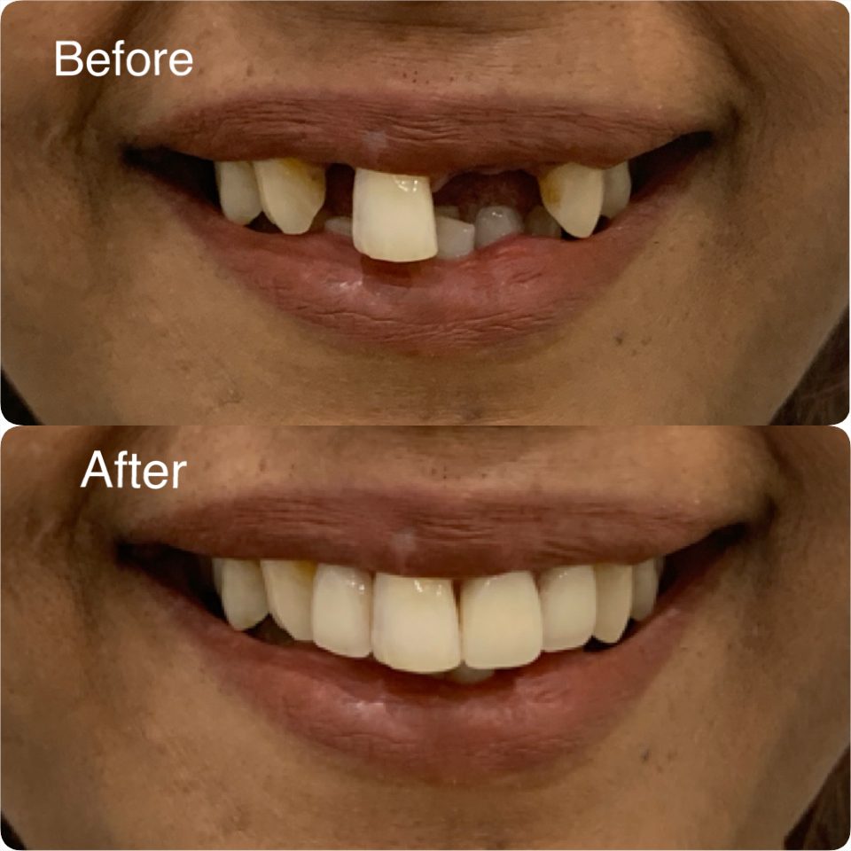 Dentures Dentures before and after — a full smile restored
