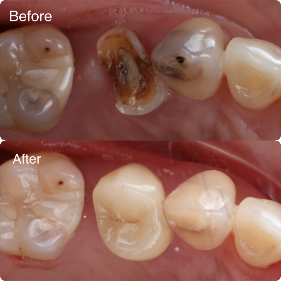 Filling Tooth decay removed and restored with a filling