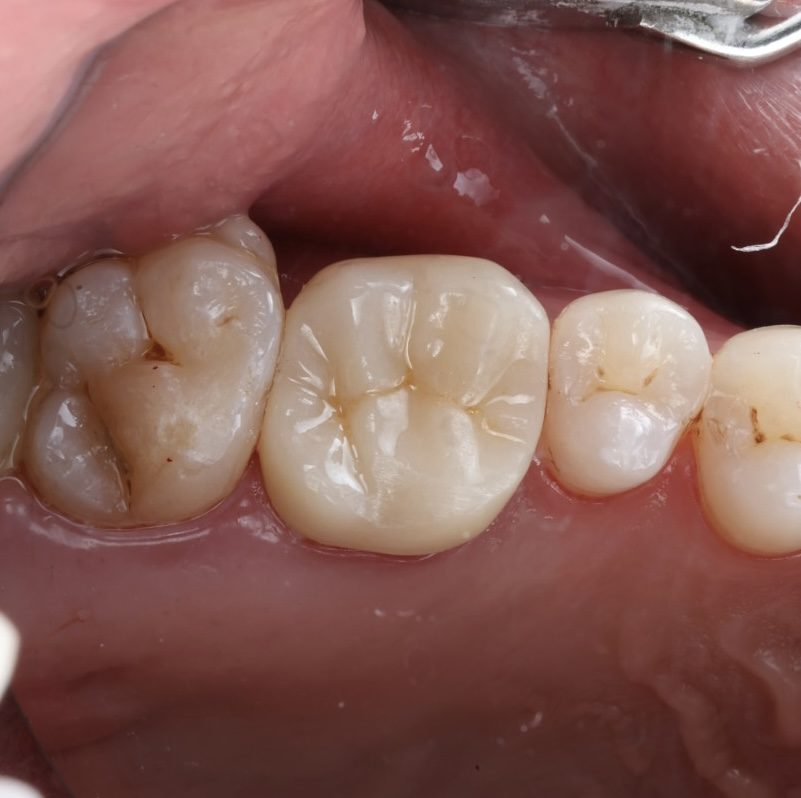 Filling Natural-looking tooth-coloured fillings