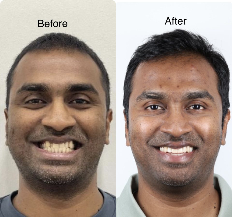 Clear aligner treatment before and after