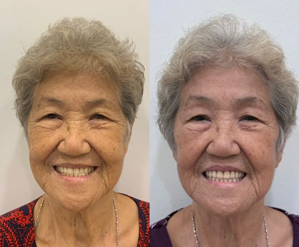 A full smile restored with dentures
