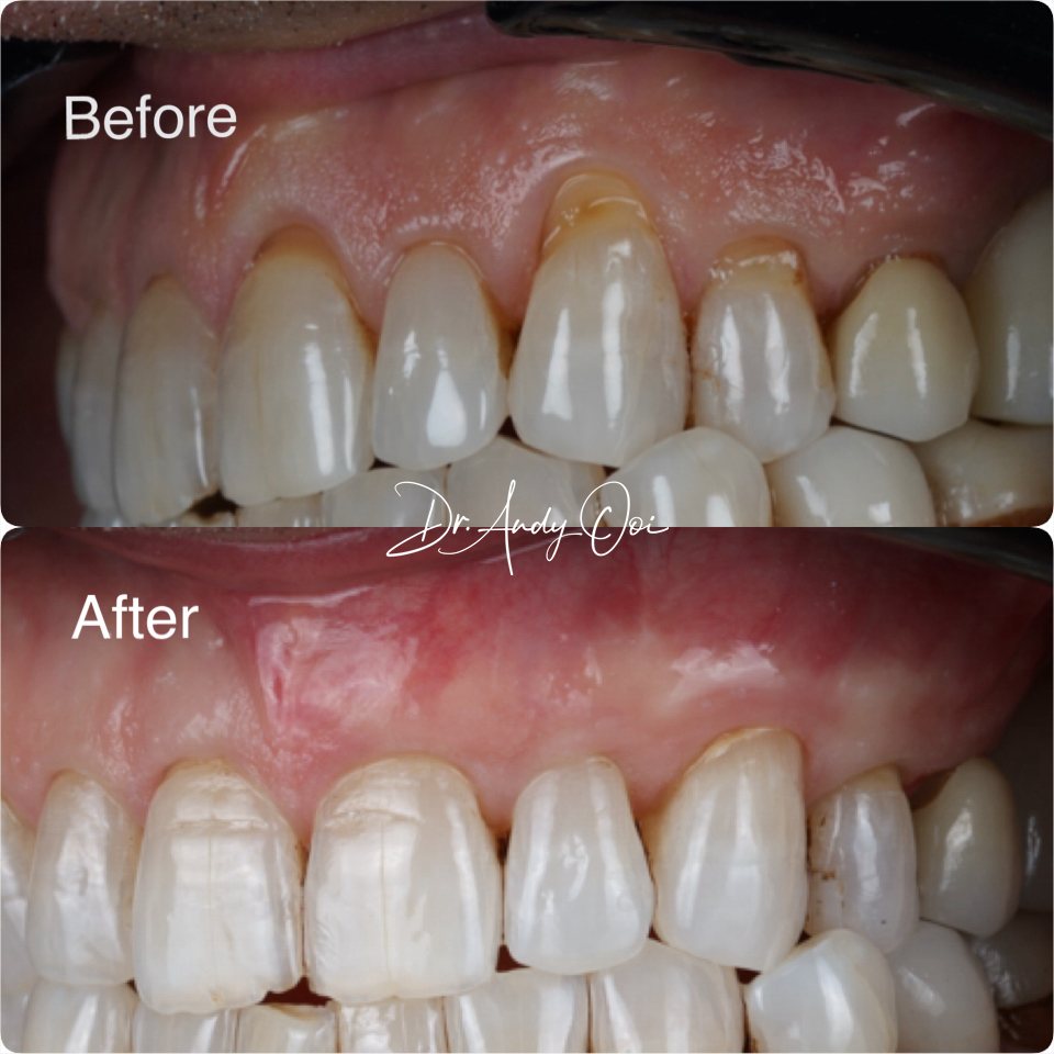 Gum recession treated and covered