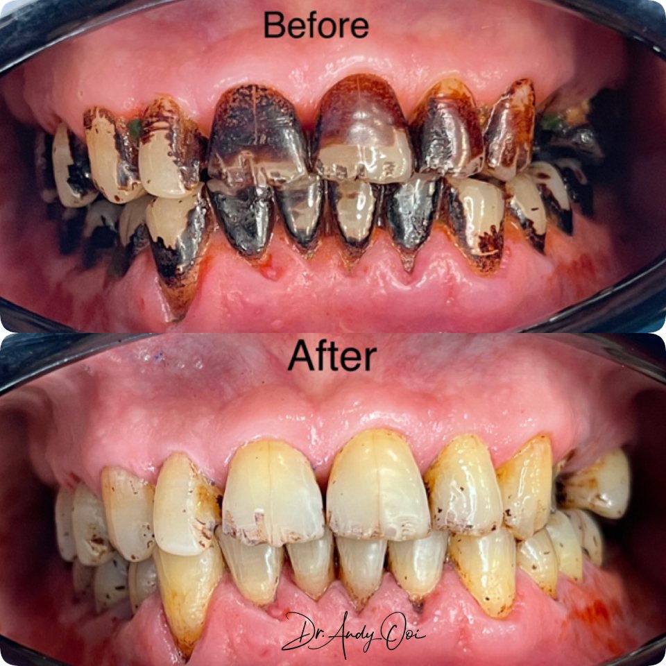 Heavy staining and tartar removed