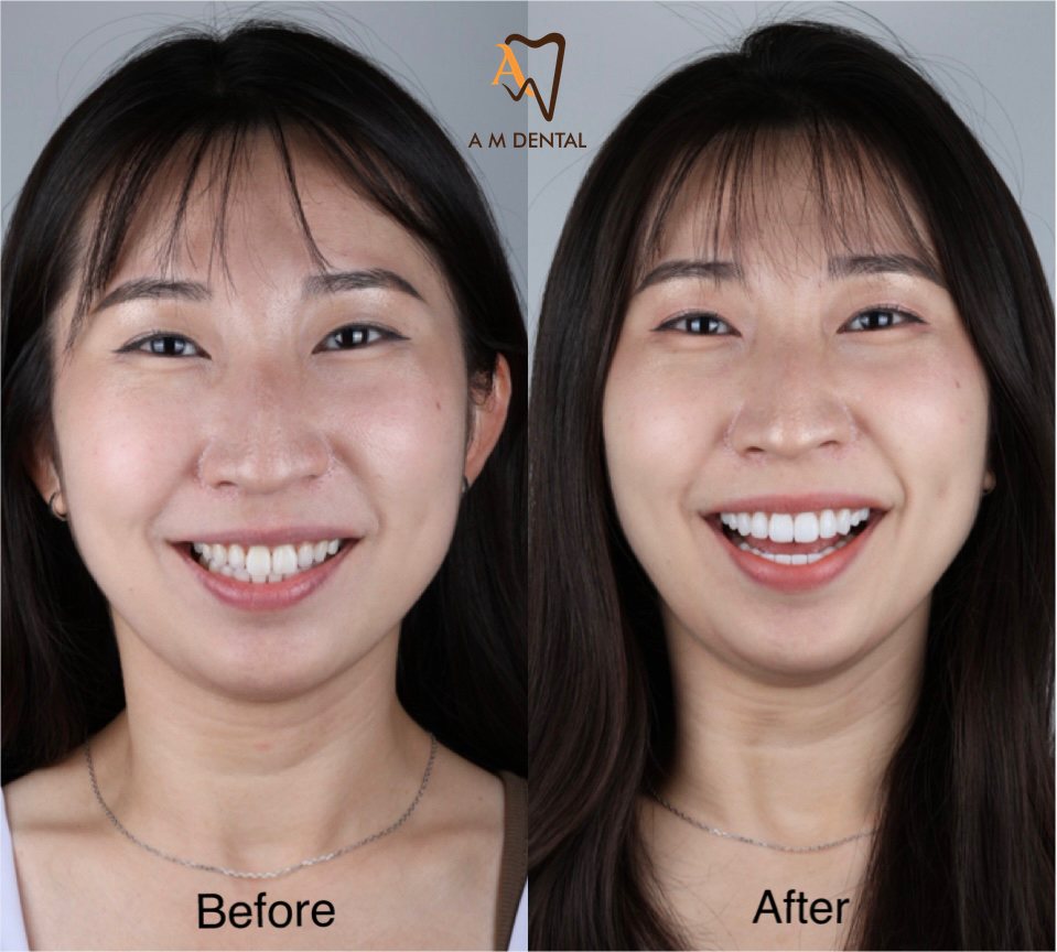 Full smile makeover before and after at A M Dental