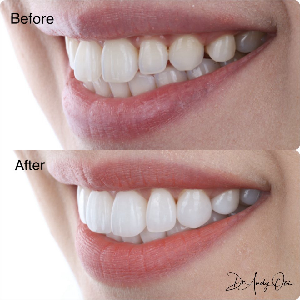 Porcelain veneers before and after