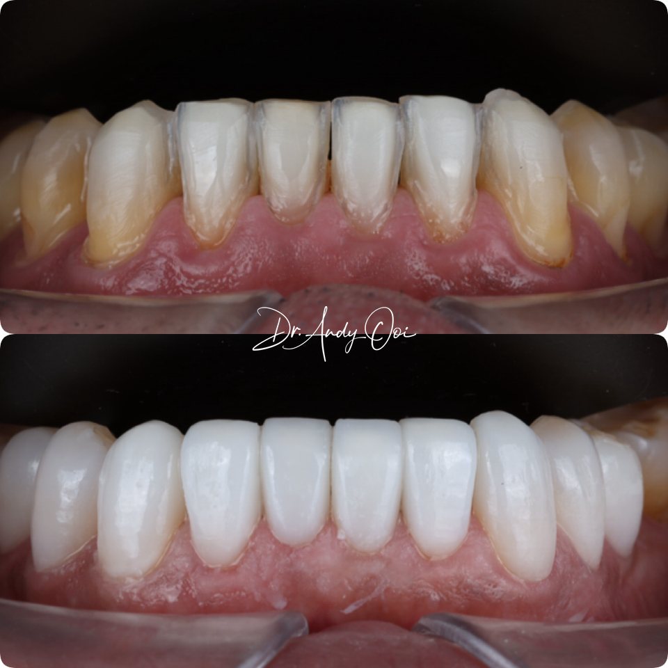 Worn front teeth reshaped with veneers