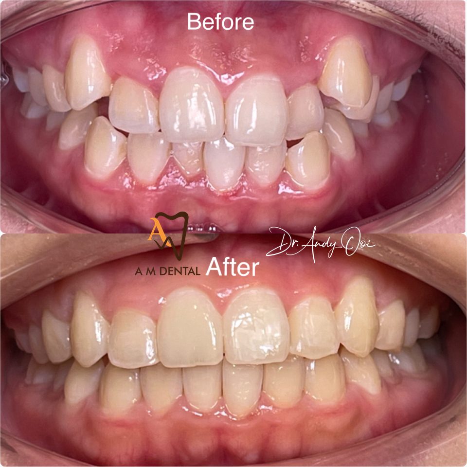 angel aligner Teeth straightened with clear aligners, before and after