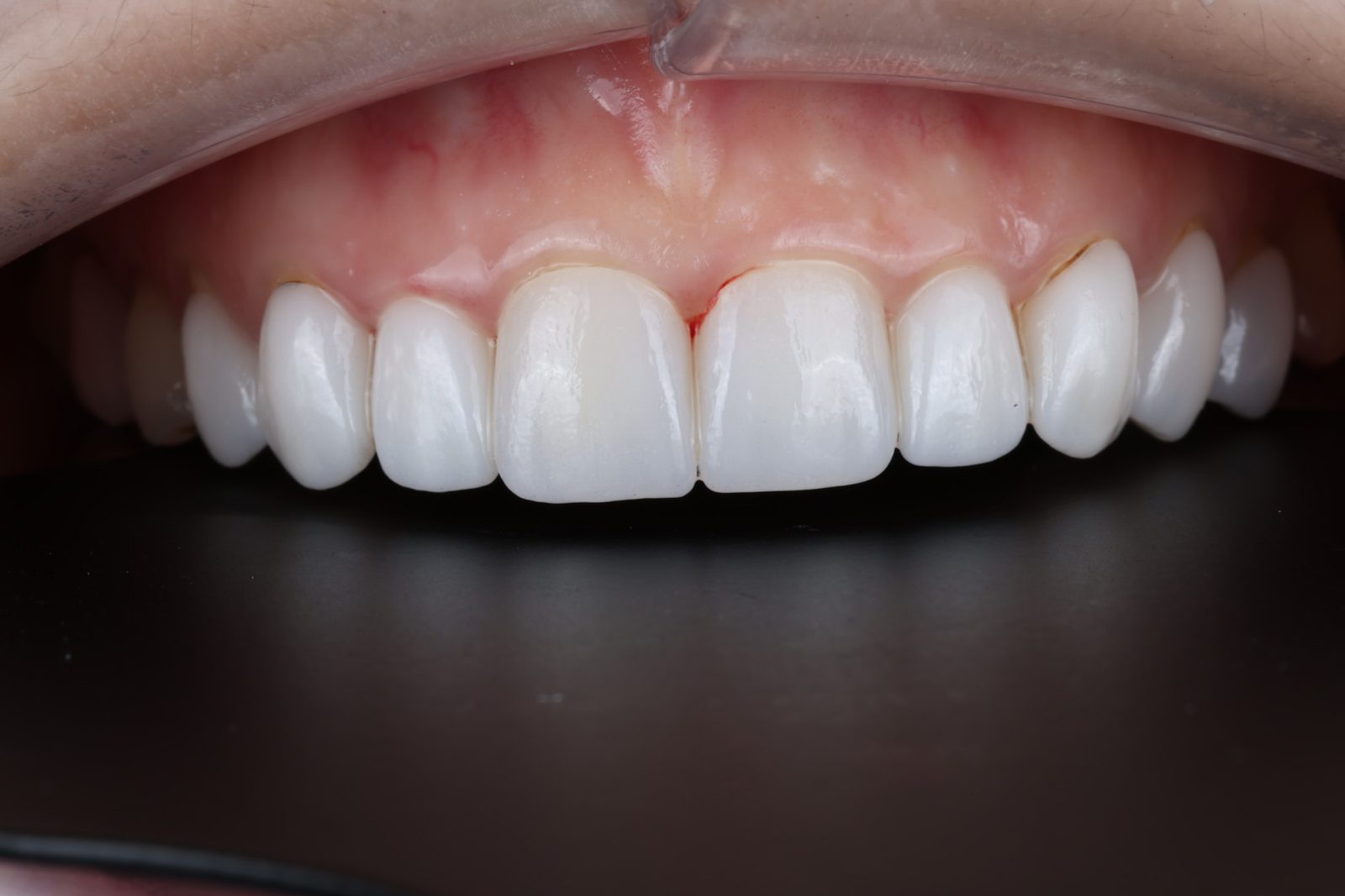 Our Treatments Brighter, refreshed teeth