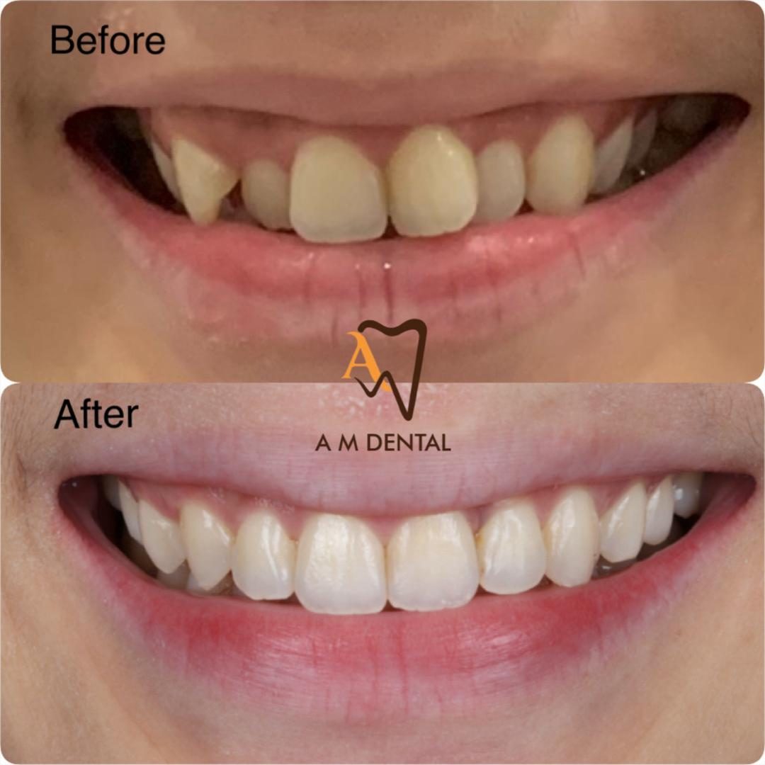 A smile makeover planned with Digital Smile Design