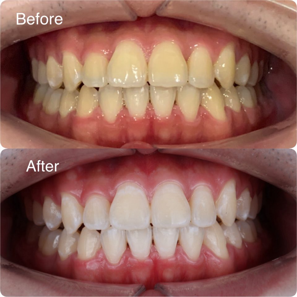 Teeth whitening before and after