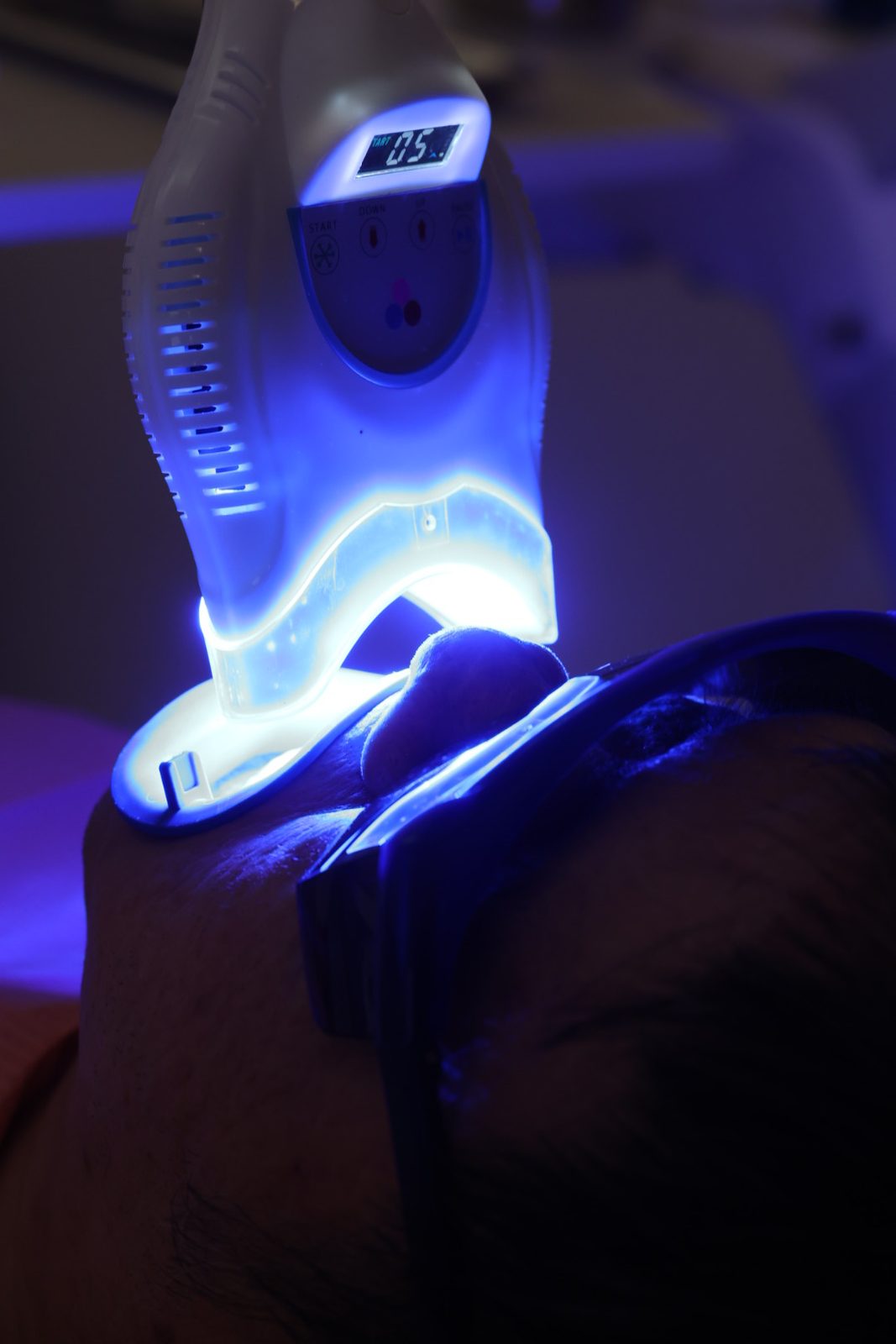 In-clinic LED teeth whitening in progress