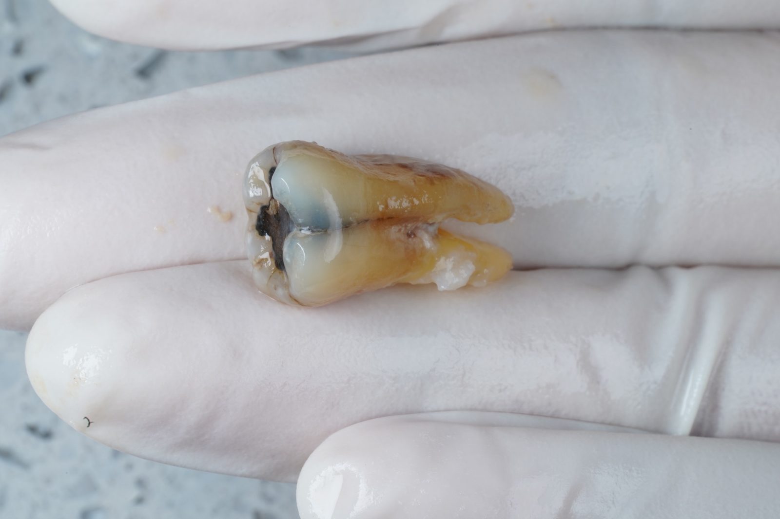 An extracted molar after a straightforward removal