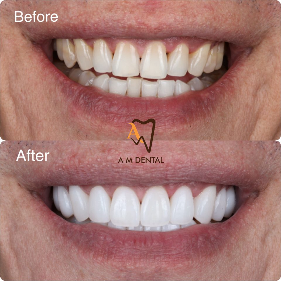 Veneers before and after