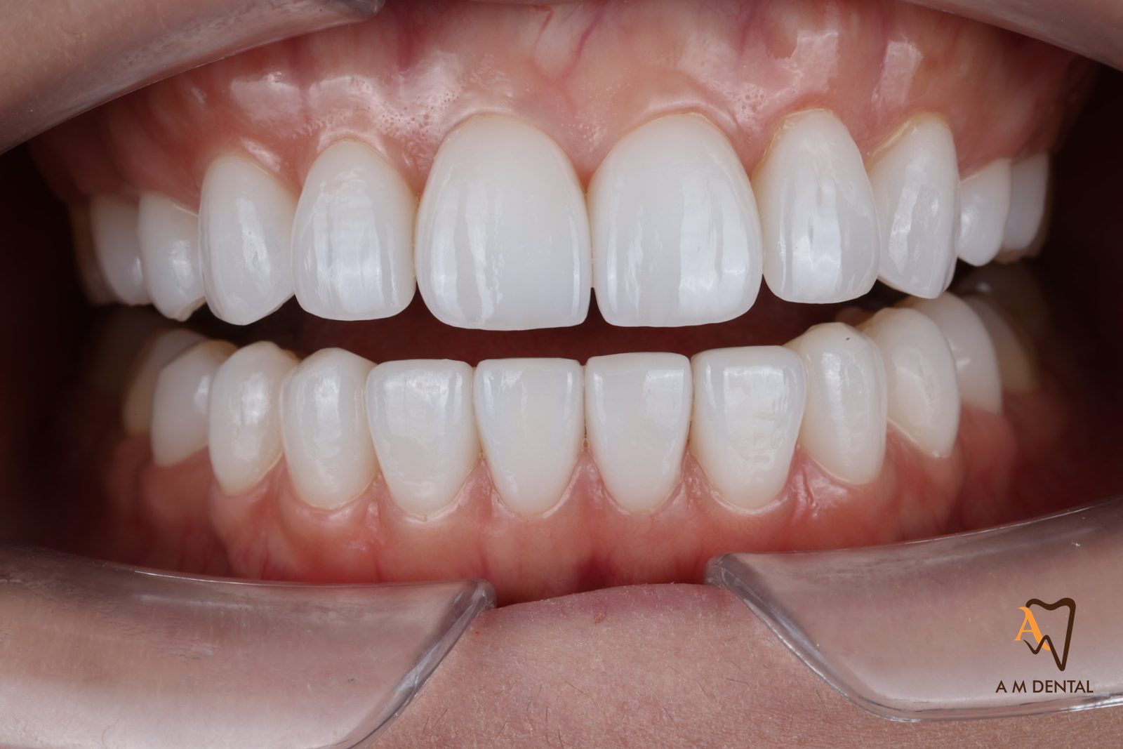 Natural-looking porcelain veneers